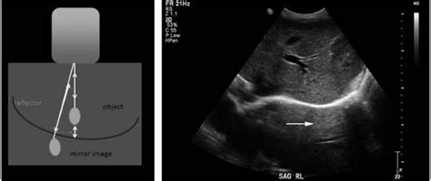 A Review Of Common Us Artifacts — Temple Point Of Care Ultrasound