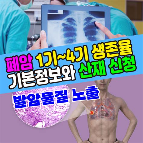 건강기본정보 폐암 진단1234기 생존율과 산재보험 신청 네이버 블로그