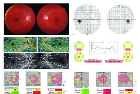 At 3 Years Fundus Examination Upper Left Shows A Mild Temporal