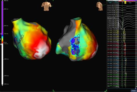 Advisor Hd Grid Mapping Catheter Se Case Library Abbott