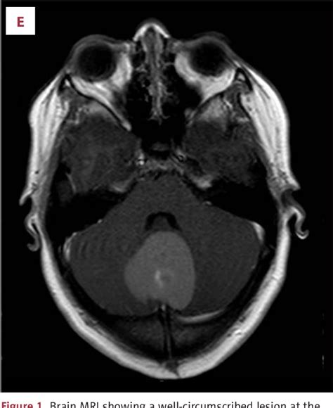 Figure 1 From A Rare Case Of An Intracranial Dermoid Cyst With Atypical