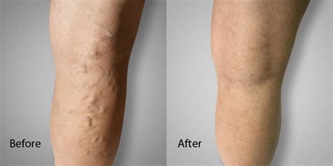 Best Treatments For Varicose Veins