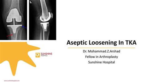 Aseptic Loosening In Tka Ppt