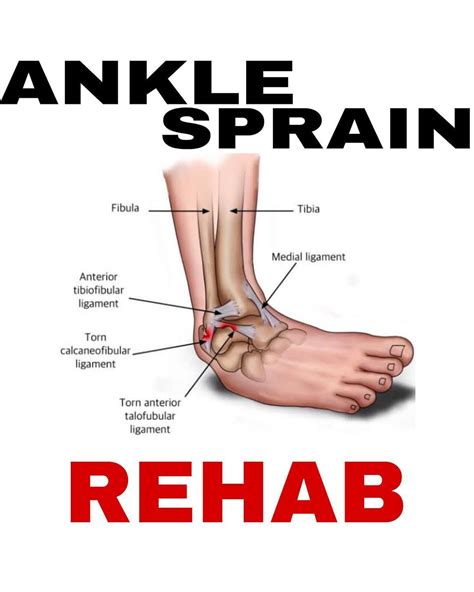 Sprained Vs Broken Ankle Artofit