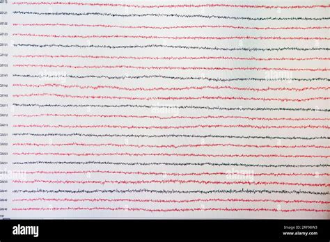 La Magnetoencefalograf A Meg Es Una Neuroimagen Que Registra La