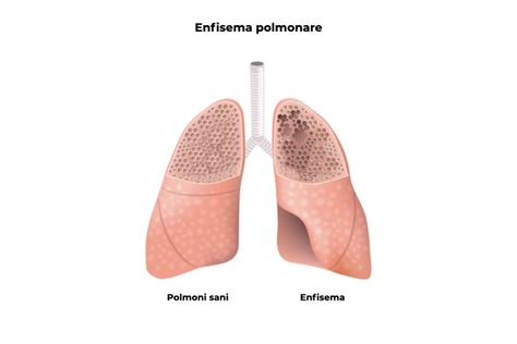 Enfisema Polmonare Sintomi Diagnosi E Trattamenti