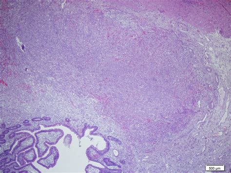 Hematoxylin And Eosin Stain Showing Small Intestine Submucosa Attacked