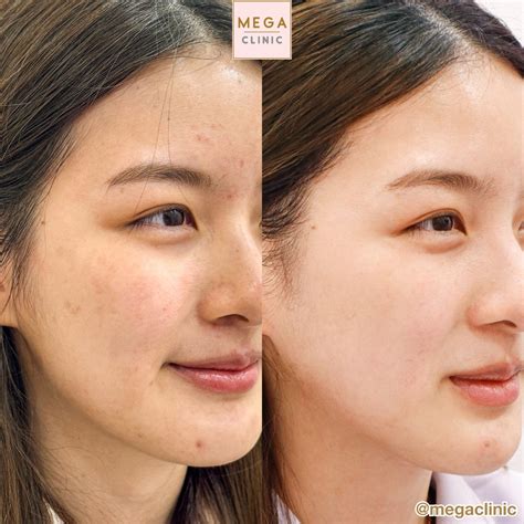 Glass Skin ต่างจากหน้ามันอย่างไร ผิว “glass Skin” ต้องทำอะไรบ้าง