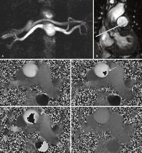 Magnetic Resonance Angiography: Technique | Radiology Key