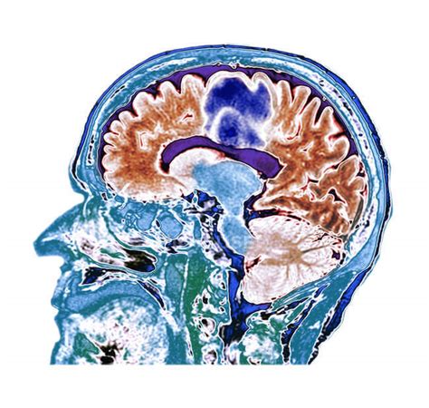 Farbige Computertomographie des Gehirnschnitts einer älteren Patientin