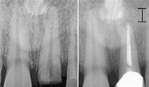 Radiograph Showing Tooth 21 Before A And After Extrusion And Final Download Scientific