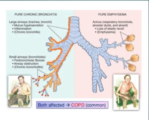 COPD Flashcards Quizlet