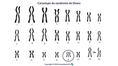 Journée mondiale de la trisomie 21 Réussis ton IFSI