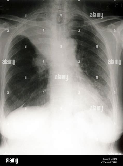 Chest X Ray Right Upper Lobe Collapse Stock Photo Alamy