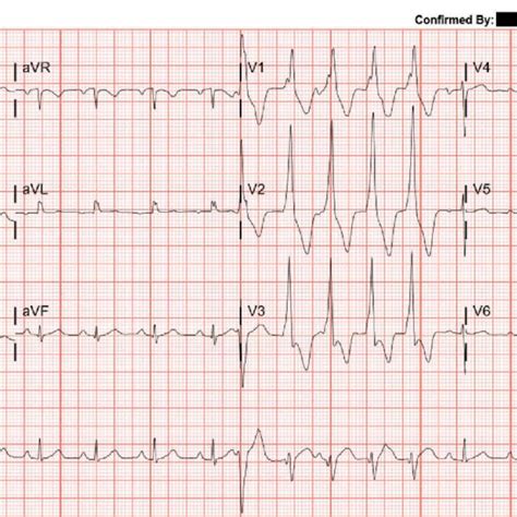 The Patients Ekg Showing Non Sustained Ventricular Tachycardia Download Scientific Diagram