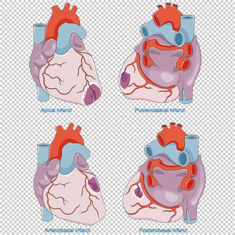 Vector De Infartos De Miocardio