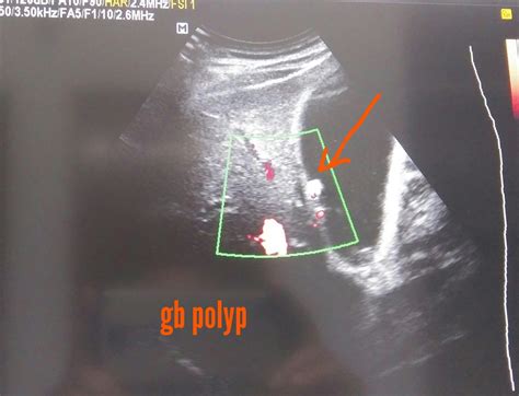 Ultrasound imaging: Gall bladder polyp 3D ultrasound