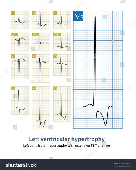 139 Left Ventricular Hypertrophy Images, Stock Photos & Vectors ...