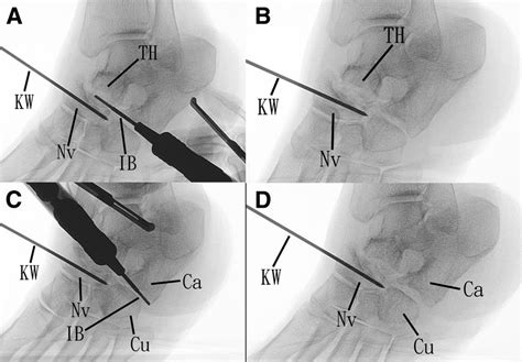 Arthroscopic Triple Arthrodesis In The Management Of Chronic Flatfoot