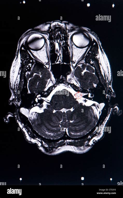 ACOUSTIC NEUROMA, MRI Stock Photo - Alamy