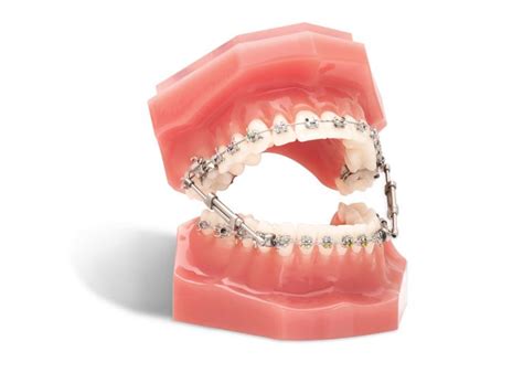 Truease Class Ii Iii Bite Corrector Device Ortho Technology