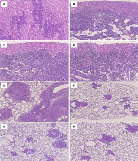 Histopathological Analysis Of Metastasis In Lymph Nodes A D And Lungs