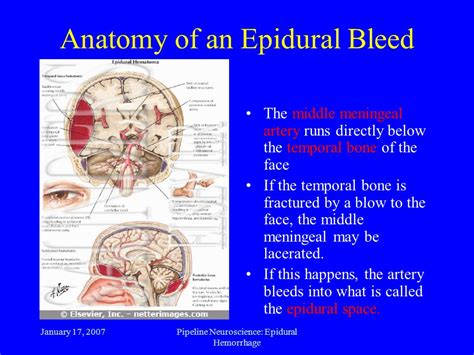 Middle Meningeal Artery Epidural Hematoma