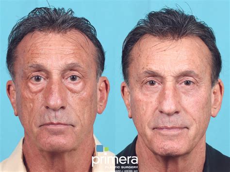 Blepharoplasty Before And After Pictures Case 898 Orlando And Tampa