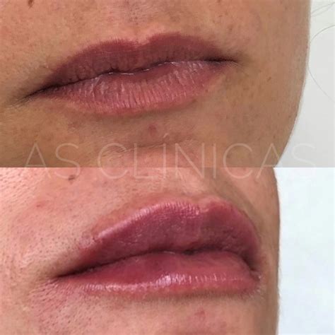 Preenchimento Labial Caso 4 As Clínicas