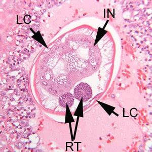 Angiostrongyliasis