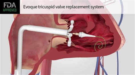 FDA Approves Edwards Lifesciencesâ Evoque Tricuspid Valve Replacement ...