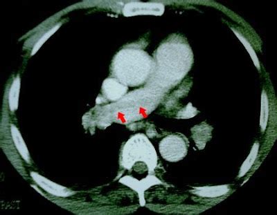 CT/USI: CTA Chest