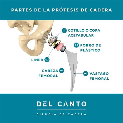 Partes De La Pr Tesis De Cadera Doctor Del Canto