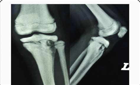 AP And Lateral Plain Radiograph After 8 Months Shows Features Of