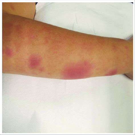 Erythema Nodosum Arms