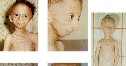 Malattie rare, Rare diseases: Progeria, Progeria disease