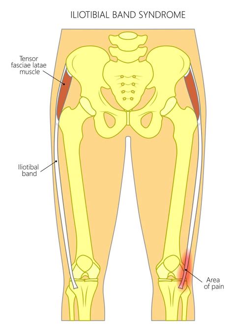 Iliotibial Band Syndrome Solution