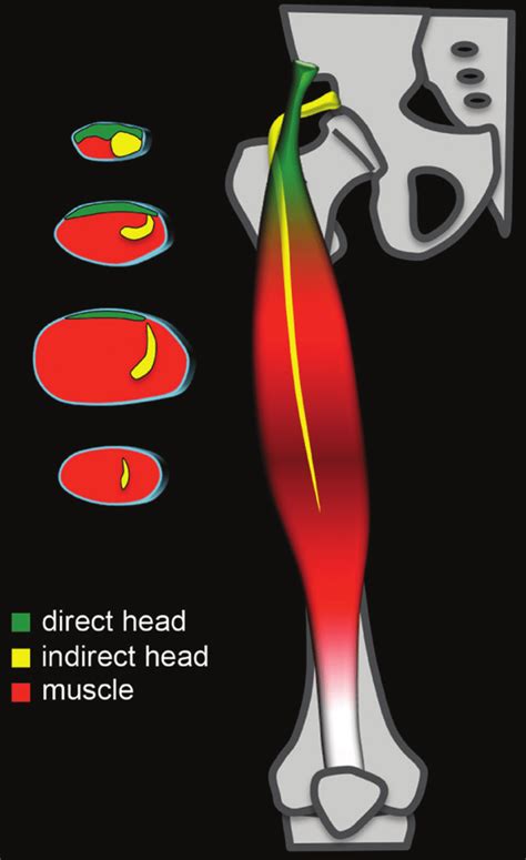 Rectus Femoris Muscle Mri Anatomy