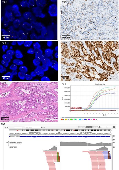 Frontiers Evaluation Of NTRK Gene Fusion By Five Different Platforms