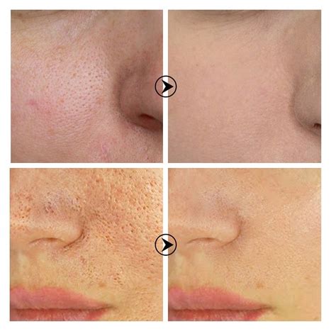 Salicylic Acid Before And After