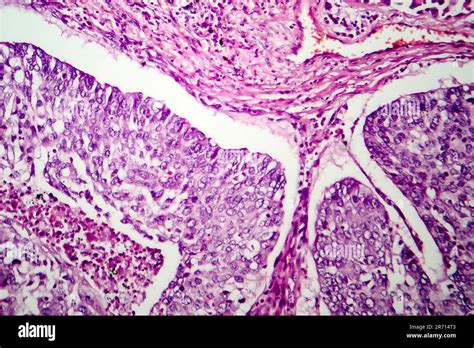 Lung Adenocarcinoma Light Micrograph Photo Under Microscope Stock