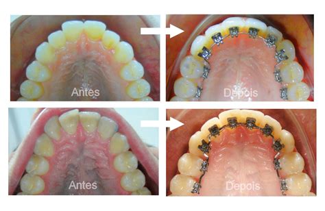 Aparelho lingual preço Ortodontista net