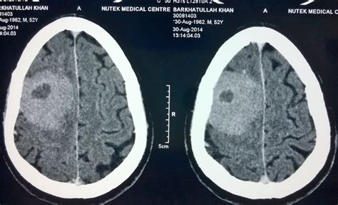 Brain Tumors | Mumbai Neurosurgical Group