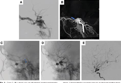 Figure 3 From Usefulness Of Stent Assisted Coil Embolization Of Direct