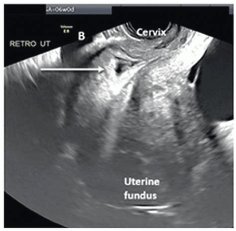 Cesarean Scar Pregnancy Diagnosis And Management Obgyn Key