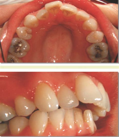 Invisalign Before And After Overjet