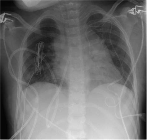 Hickman Central Venous Catheter