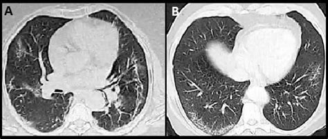 Axial A B Images Of Screening Hrct Of Two Different Patients From