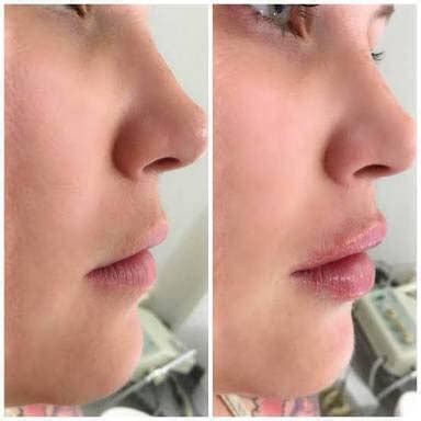 Alondra Pegajoso Punto De Partida Preenchimento Labial Antes E Depois