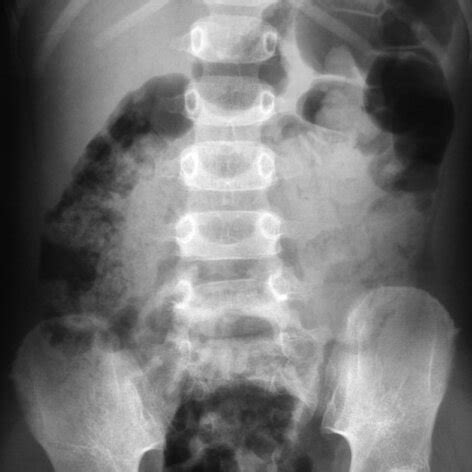 Abdominal radiograph reveals distended bowel loop with fecal materials. | Download Scientific ...